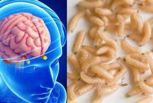 Un Hombre sufre migraña debido a gusano en el cerebro