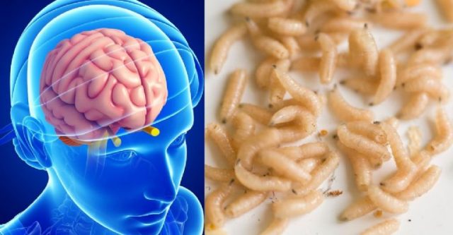 Un Hombre sufre migraña debido a gusano en el cerebro
