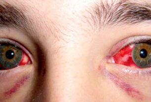 ¿Qué es la fiebre hemorrágica Crimea-Congo?