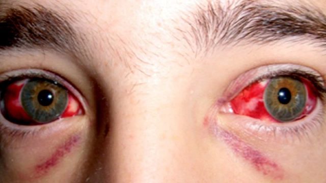 ¿Qué es la fiebre hemorrágica Crimea-Congo?