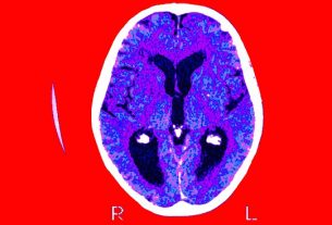 FDA Aprueba Donanemab: Medicamento para retrasar el Alzheimer