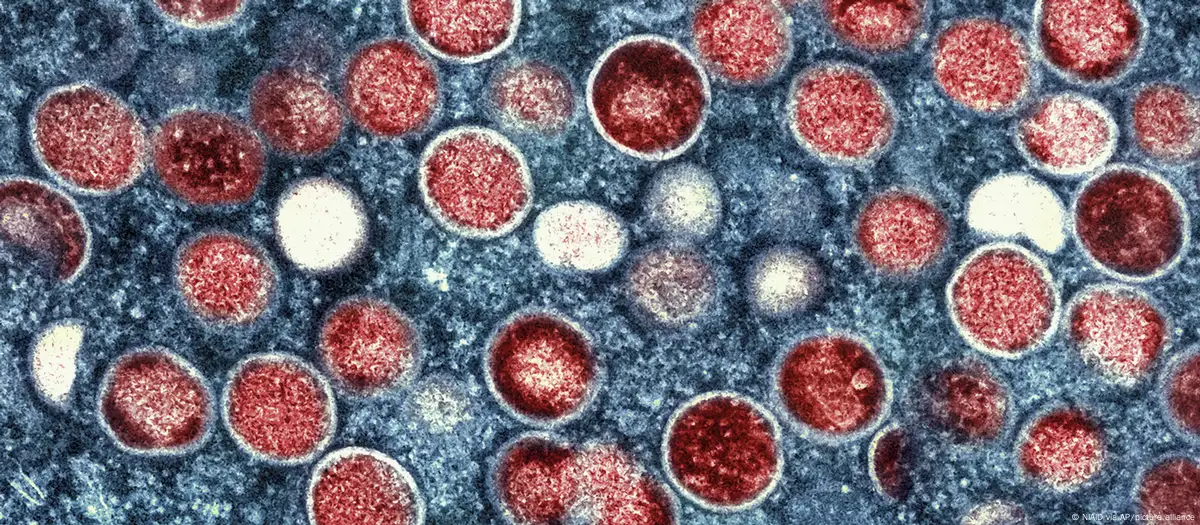 Mpox América Latina sigue mal preparada