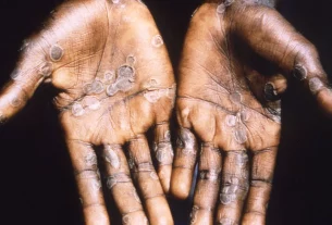 OMS declara el mpox como emergencia internacional de salud