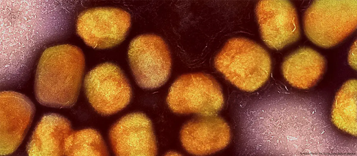 Suecia confirma primer caso de variante peligrosa de mpox