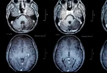 Vacuna contra tumores cerebrales da nueva esperanza