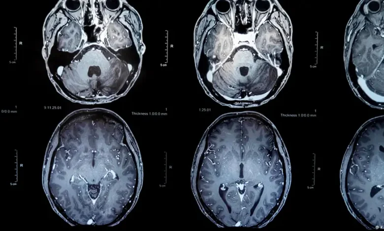 Vacuna contra tumores cerebrales da nueva esperanza
