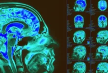Mapa celular del cerebro revela claves de enfermedades