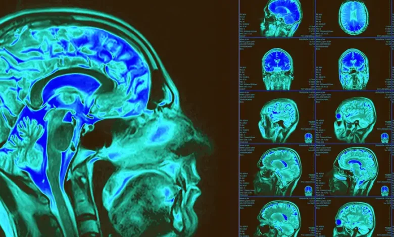 Mapa celular del cerebro revela claves de enfermedades